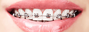 How Are Braces Put On: A Breakdown Of The Process And What To Expect