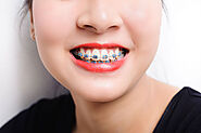 A Complete Guide to Braces in Singapore: Types of Braces, Prices & FAQs