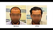 Best Hair Transplant Clinics In India - RESULTS OF THE MONTH | DHI India