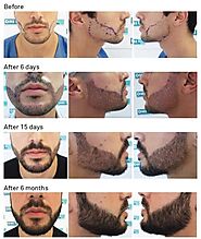 Beard Restoration Treatments DHI India