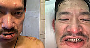 Vietnamese American man has his bones broken in racist attack - HOPCLEAR