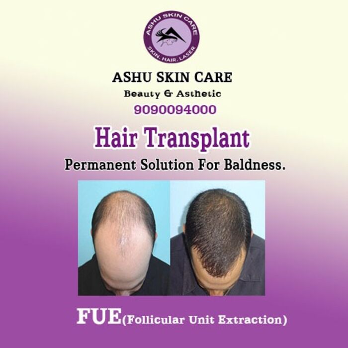 Hair Transplant in Bhubaneswar - No-1 Hair Transplant Clinic in Bhubaneswar - Hair Restoration Clinic in Bhubaneswar ...