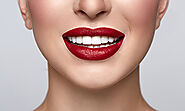 Veneers - Most recommended dental clinic in Dubai