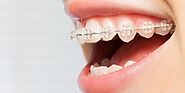 CERAMIC BRACES - Most recommended dental clinic in Dubai
