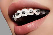 METALLIC BRACES - Most recommended dental clinic in Dubai