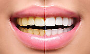 TEETH WHITENING - Most recommended dental clinic in Dubai