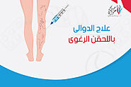 كيفية علاج دوالي الساقين بدون جراحة | دكتور حسين علوان