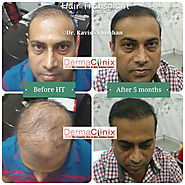 Hair Transplant Delhi India