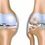 Some Important Things to Know About Knee Surgery in Indore | Dr. Sachin Chhabra
