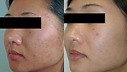 Get Best Acne Scar Treatment Services in San Mateo