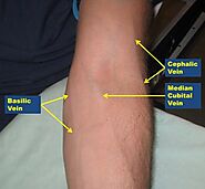 Phlebotomy: Background, Indications, Contraindications