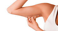 Arm Lift Cosmetic Surgery