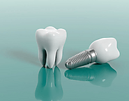 From Missing Teeth to Radiant Smiles: How Dental Implants Can Transform One's Life