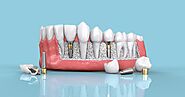 Expert Tips for Finding the Best Oral Surgeon for Dental Implants
