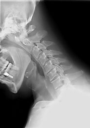Global Spinal Implants Market to be Worth US$15.984 billion by 2024