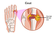 Chế độ ăn cho người bị bệnh Gout