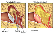 Phương pháp điều trị viêm tai giữa hiệu quả