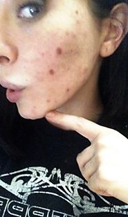 My PCOS Cystic Acne Flare Ups!