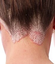 Psoriasis Treatment in Ludhiana