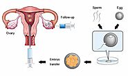 Embryo Transfer Technique and Process | ETT in IVF or ICSI | Indira IVF