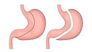 Transform Your Life with Effective Gastric Sleeve Surgery in Maryland