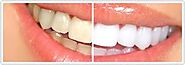Aesthetic Dentistry Treatment in South Delhi - SouthEx Dental