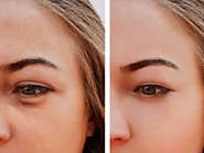 Top Under Eye Filler Toronto