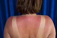 How to Differentiate Between Sunburn and Sun Poisoning? A Detailed Guide
