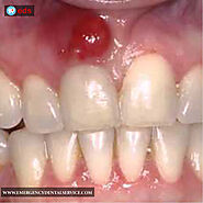 Types of Dental Abscesses