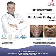 Best Lip Reduction Surgery Clinic in Delhi, Lip Reduction Cost South Delhi