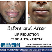 Best Lip Reduction Surgery Clinic in Delhi