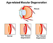 Is Macular Degeneration Hereditary? Know It Today | Health Clubfinder