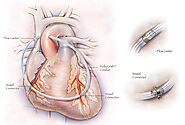Bypass Heart Surgery