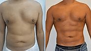 The Advantages Of VASER Liposuction