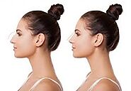 REVISION RHINOPLASTY: FIXING A BAD NOSE JOB