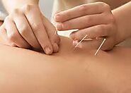 Dry Needling