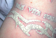 What are the Different Types of Tattoo Removal?