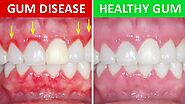 Gum Disease – Eternal Smiles Dental Implant, Braces and Cosmetic Centre