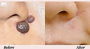 Can A Mole Grow Back After Removal? ~ Beauty Treatments