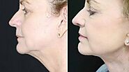 What to Expect During Neck and Jawline Lift Recovery?
