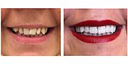 Best Dental Clinic For Hollywood Smile Makeover in Dubai | Euromed® Clinic