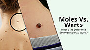 Moles Vs. Warts: What's Difference Between Moles & Warts | Skin City