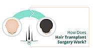How Does Hair Transplant Surgery Work? – Skin City India