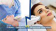 Laser Lipolysis Vs Ultrasound Cavitation – Skin City India