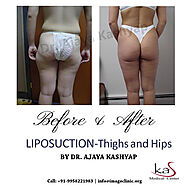 Liposuction - thigh and hips