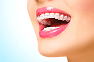 Basics Of Dental Braces | Fostr Multispeciality Clinic