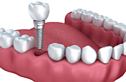 Know How Dental Implants Surgery Proceed