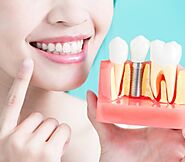 Everything You Need to Know About Dental Implant Surgery