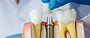 A Comprehensive Guide About Dental Implants, Their Advantages, and Steps to Follow