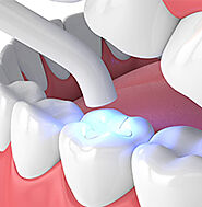 Dental Filling Calgary | Front Tooth Filling | Galaxy Dental